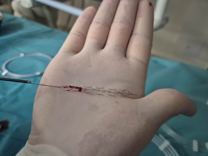 Zabieg 2 Trombektomia mechaniczna u noworodka